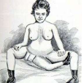 Blanche Dumas, femme à deux vagins 